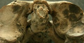 Artrosis cervical en un hombre fallecido a los 40-50 años y procedente de la tumba 5 del Convento Madres Mercedarias de Lorca (Rihuete 2006).